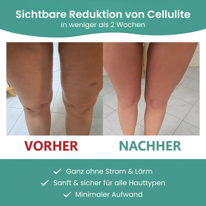 Cellulite-Roller